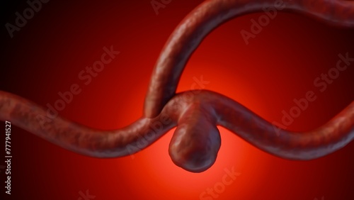 3d rendering of a saccular aneurysm, also known as a berry aneurysm, is a bulge that forms on the wall of a blood vessel in the brain photo