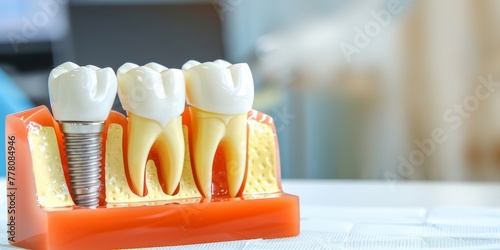 A close-up view of a dental model showcasing a tooth and a dental implant, illustrating dental implant procedure and restoration © tashechka