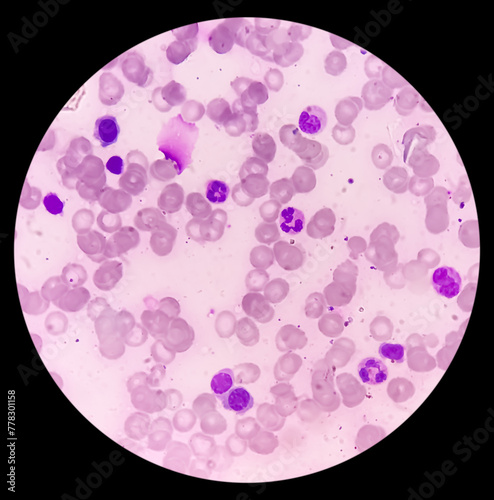 Bone marrow study (BMD). Myelodisplastic syndrome (MDS) or Refractory anemia. It's a group of cancers in which immature blood cells in the bone marrow. Myelodysplasia. photo