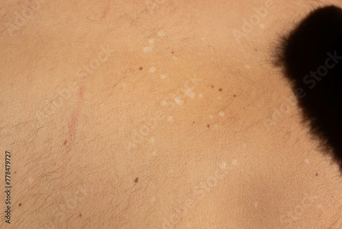 Skin Condition: Tinea Versicolor. Lack of pigmentation photo