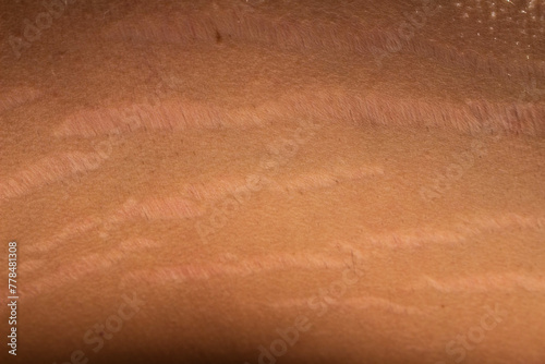 Male Body: Stretch Marks and Weight Changes