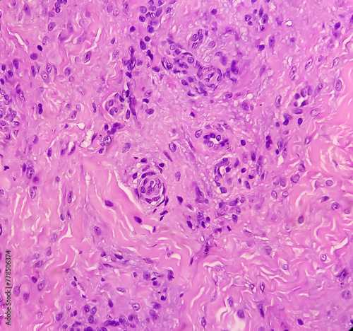 Tendon sheath (biopsy): Chronic synovitis. smear show area of fibrosis and infiltration of inflammatory cells. Villonodular synovitis. photo