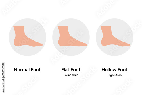 Normal, flat and hollow Foot deformation 