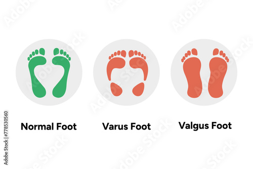 Normal, vatus and valgus Foot deformation 