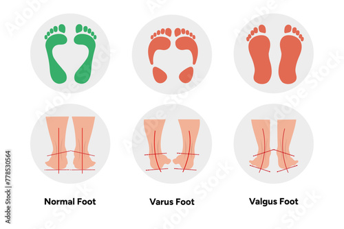 Normal, vatus and valgus Foot deformation 