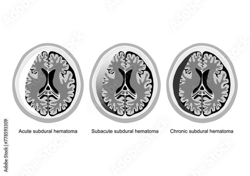 Stages of subdural hematoma brain injury illustrated..