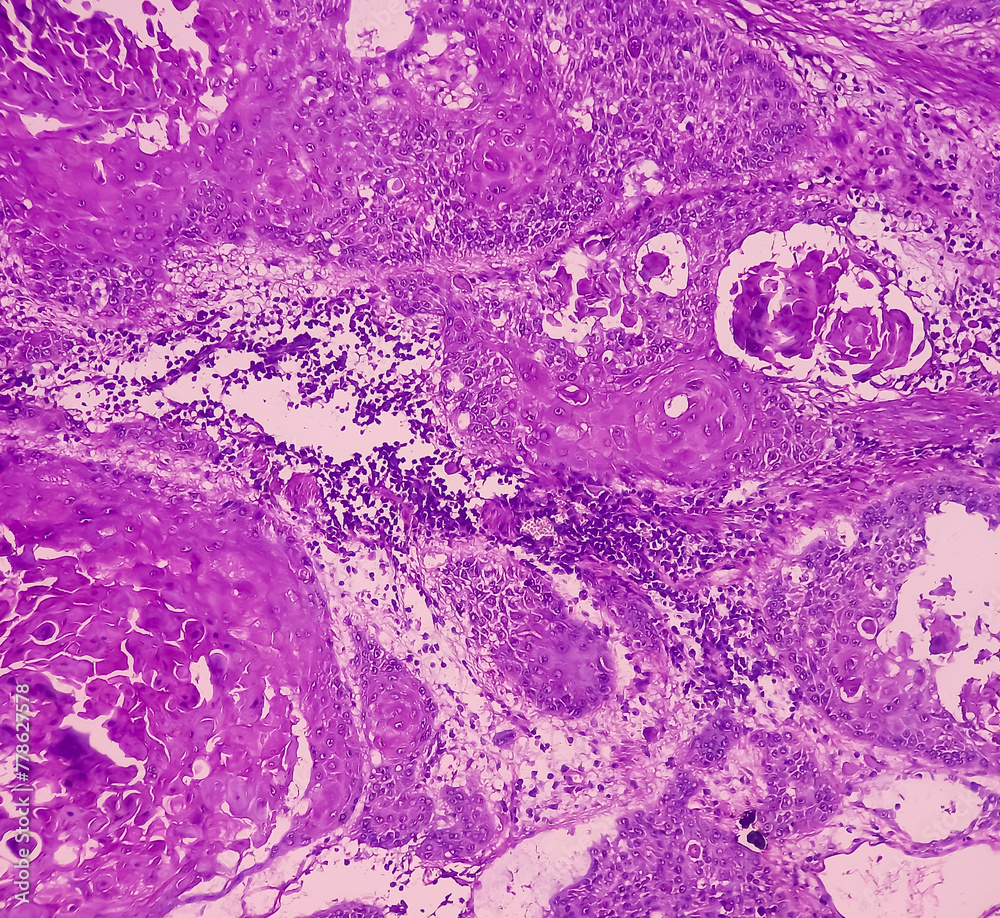 Nipple (biopsy) Invasive squamous cell carcinoma of nipple