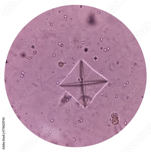 Microscopic image showing many calcium oxalate crystals from urine sediment, most common cause of kidney stones. photo