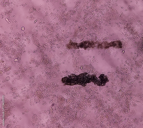Microscopic image showing many calcium oxalate crystals from urine sediment, most common cause of kidney stones. photo