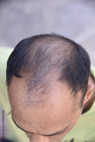 Hair loss problem