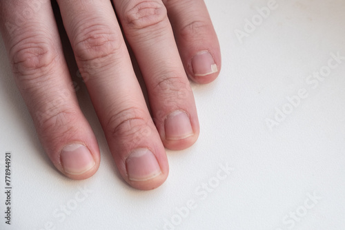 male hand with a broken nail on the little finger