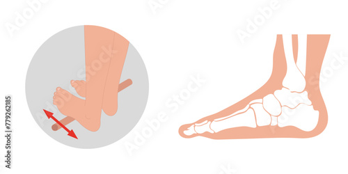 Special exercise for food deformation problem. Orthopedist Therapeutic and strengthening foot