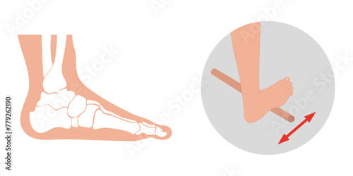 Special exercise for food deformation problem. Orthopedist Therapeutic and strengthening foot