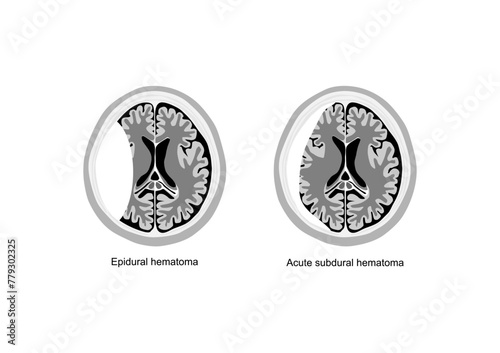 Epidural and subdural hematoma brain illustration. Traumatic brain injury.