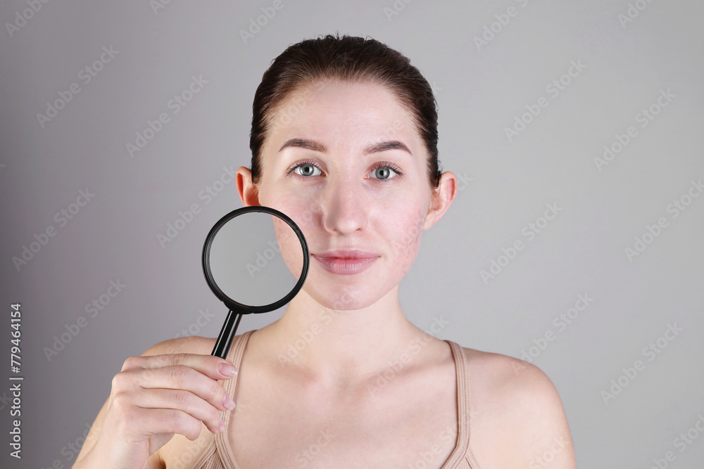 Young woman with acne problem holding magnifying glass near her skin on light grey background Young woman with acne problem holding magnifying glass near her skin on light grey background