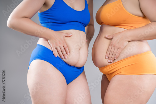 Tummy tuck  two fat women with cellulitis and flabby bellies on gray background  obese female body  plastic surgery and liposuction concept