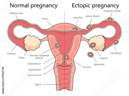 Fotografie Human normal and ectopic pregnancies with labeled female reproductive system structure diagram hand drawn schematic raster illustration