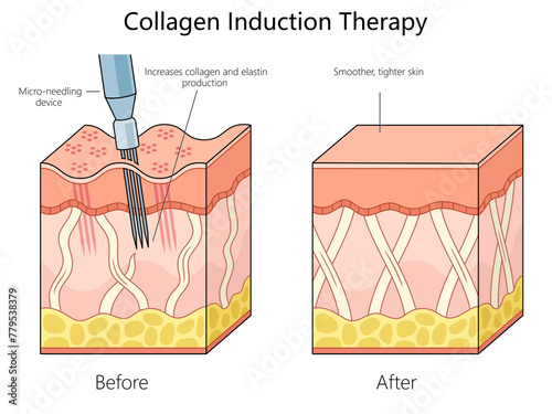 skin structure before and after collagen induction therapy using a micro-needling device for enhanced skin texture diagram schematic raster illustration. Medical science educational illustration © Oleksandr Pokusai