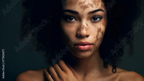 Portrait of young casual woman with vitiligo condition looking at camera close up photo