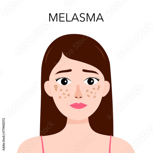 Woman with Melasma on face. Pigmentation Spots facial skin.