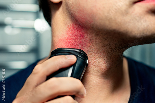 Obraz na plátne Razor burn, shave rash and skin irritation