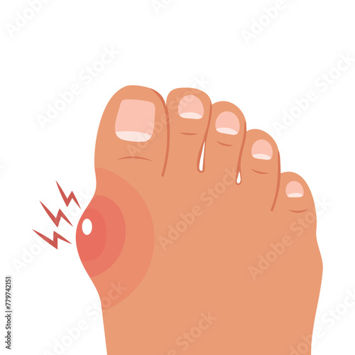 Foot with painful bunion. Healthy and sick feet. Healthcare and medicine. Illustration. Vector