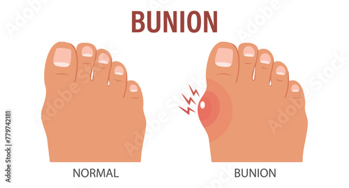 Foot with painful bunion. Healthy and sick feet. Healthcare and medicine. Illustration. Vector photo