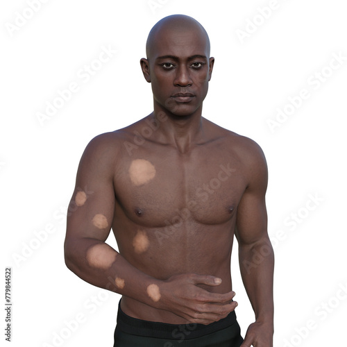 Tuberculoid leprosy, 3D illustration