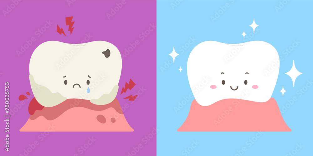 Weak tooth with lesions compare with strong tooth. Illustration of tooth decay, plaque, gum pain or gingivitis and healthy tooth. Concept of dental health, dentistry. Flat vector illustration cartoon. Weak tooth with lesions compare with strong tooth. Illustration of tooth decay, plaque, gum pain or gingivitis and healthy tooth. Concept of dental health, dentistry. Flat vector illustration cartoon.