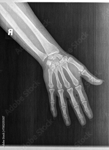 Film xray or radiograph of a normal left hand of an adult male. AP view show human's hand. normal bone structure of all phalanges carpal bones metacarpal, distal radius and ulna. joint space is normal photo