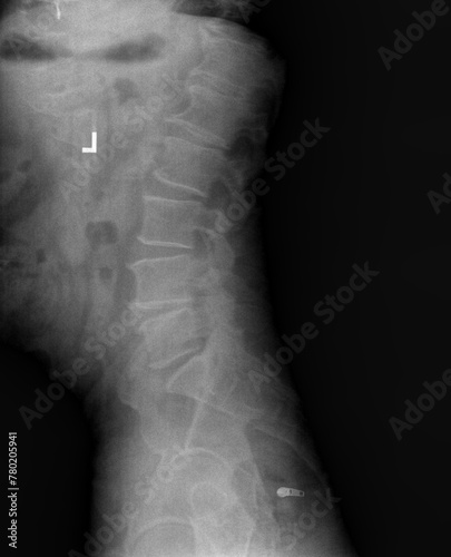 Film xray or radiograph of lumbar low back vertebrae showing facet joint syndrome of L4 L5 area which is an arthritis-like condition of the spine that can be a significant source of back and photo