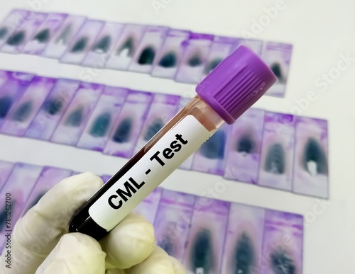 (also called CML or chronic granulocytic leukemia) photo