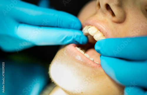A dentist places clear caps in a woman's mouth to correct her teeth. Separated, excessively crowded teeth or crossbite. Invisible orthodontic concept. Splints teeth.