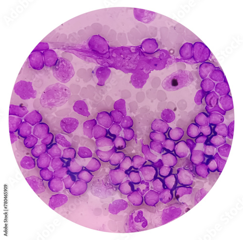 Acute leukemia, ALL(Acute lymphoblastic leukemia), peripheral blood smear, Under 100x light microscope to diagnosis of Acute leukemia.