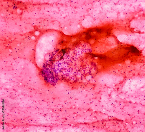CT guided FNA from abduminal mass  Spindle cell neoplasm  smear show cellular material of oval to spindle shaped cells  mild pleomorphism  blood.