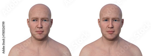 A man with exotropia and a healthy person, 3D illustration