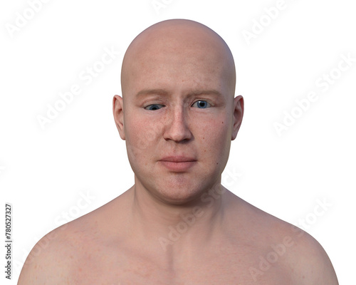 A man with hypotropia, 3D illustration