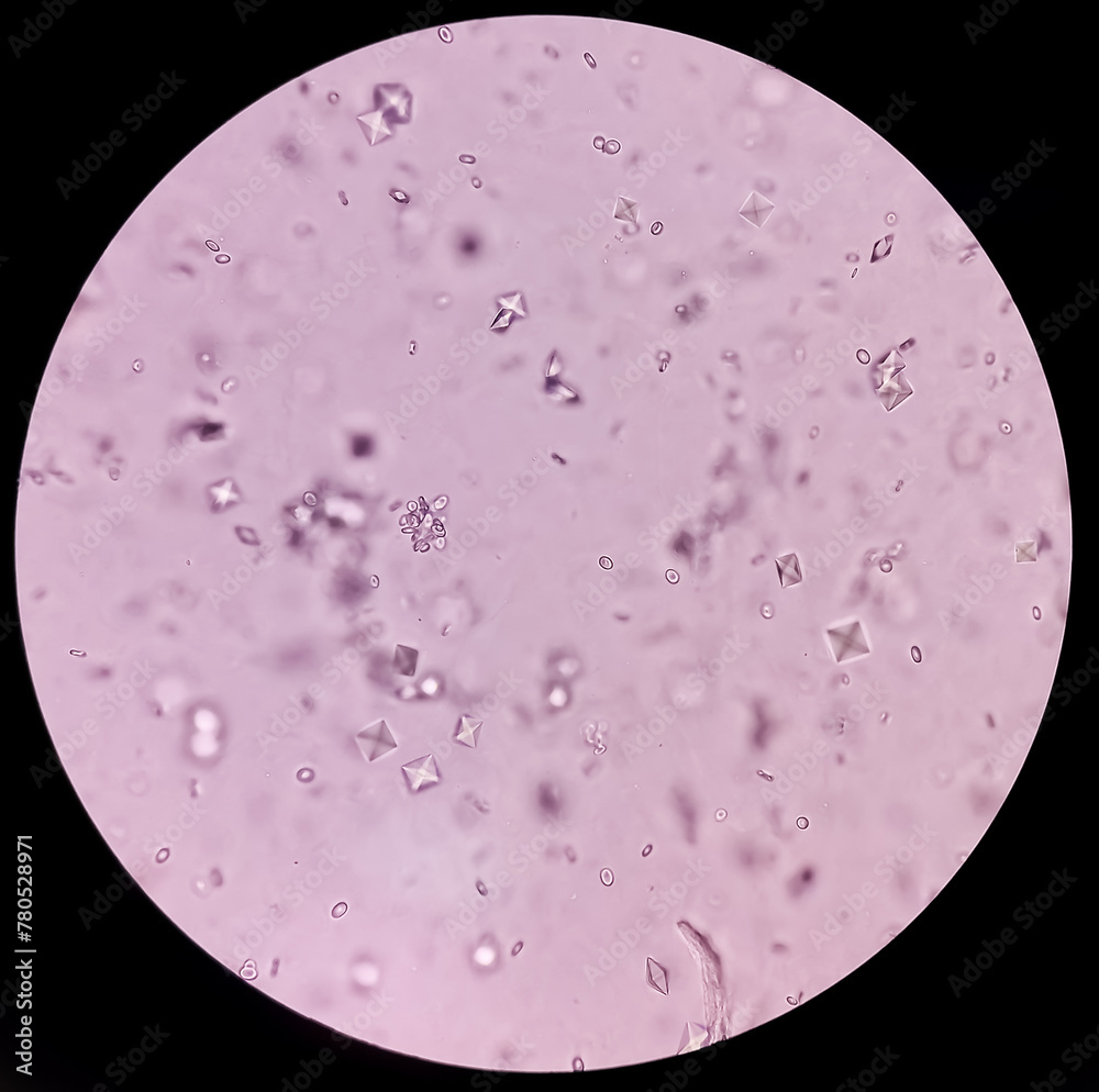 UTI. Budding yeast cells and calcium oxalate crystal in urine, urinary ...