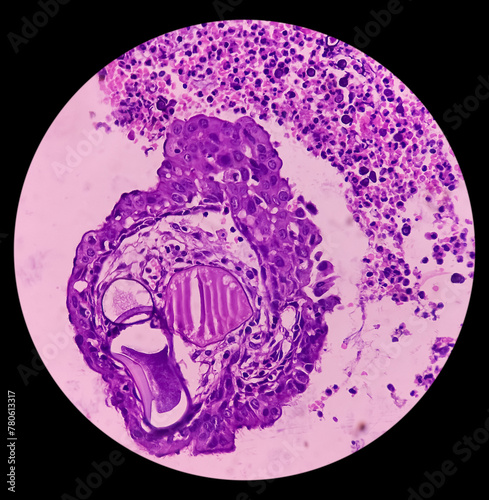 Nasal mass biopsy: Rhinosporidiosis, microscopic show large thick walled sporangia with many endospores accompanied by a mixed inflammatory infiltrate.