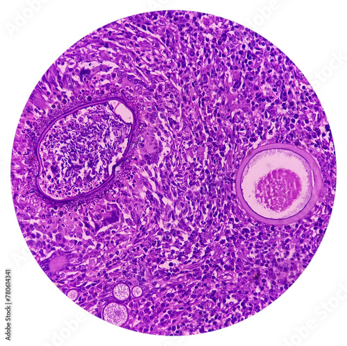 Nasal mass biopsy: Rhinosporidiosis, microscopic show large thick walled sporangia with many endospores accompanied by a mixed inflammatory infiltrate. photo