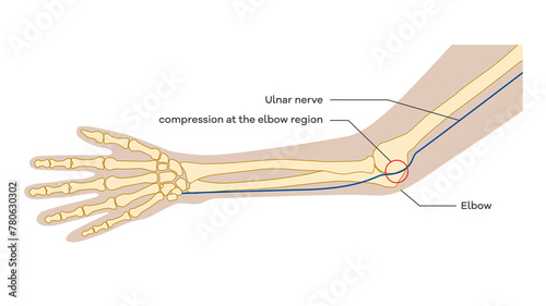 Cubital tunnel syndrome