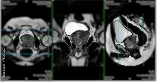 
MRI of the prostate gland reveals a focal abnormal signal intensity (SI) lesion at the left posterolateral peripheral zones at the apex, aiding in diagnosing tumors and guiding treatment decisions. photo