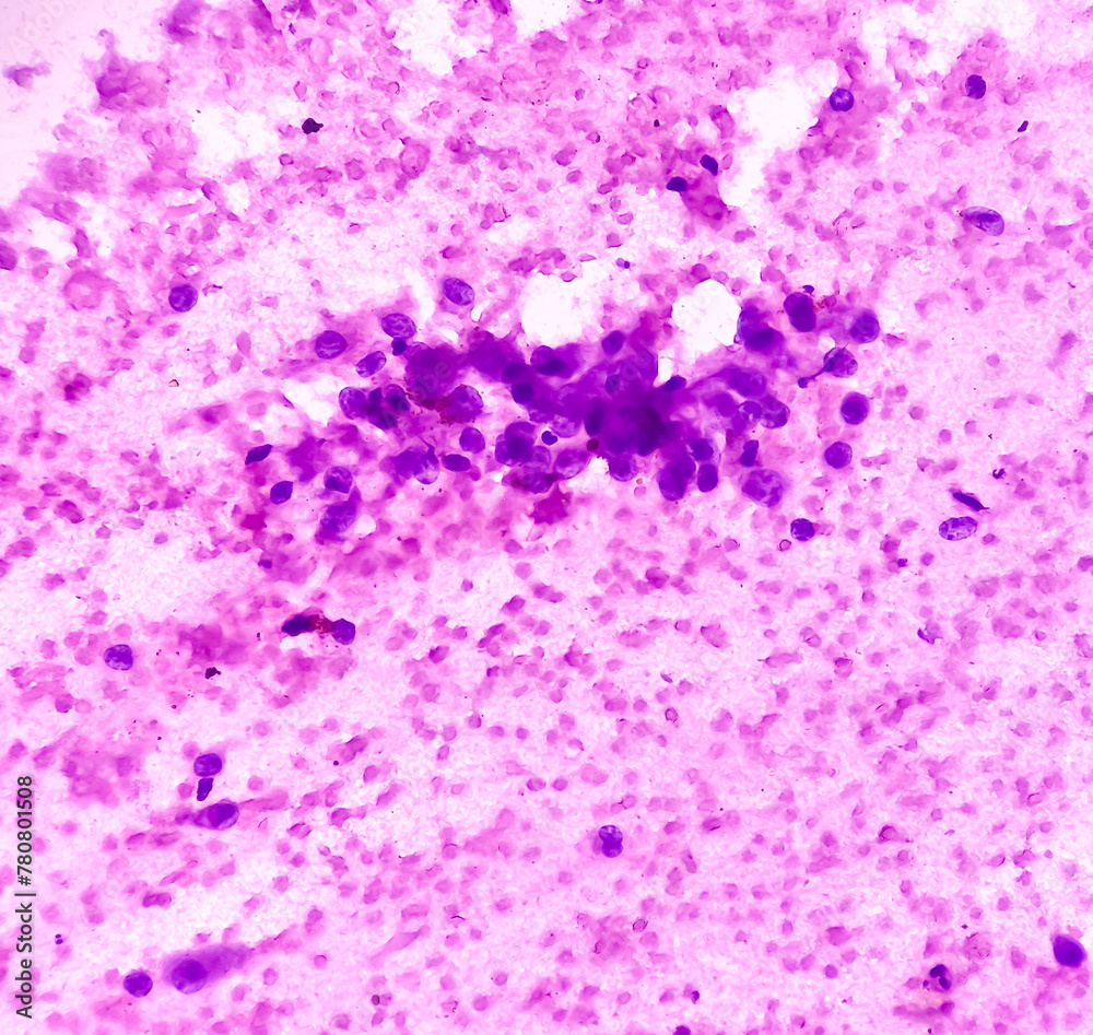 CT guided FNA from lung lesion, Chronic granulomatous inflammation (CGI) with Tuberculosis. CGI-TB. smear show clusters of epithelioid cells, lymphocytes, histiocytes, giant cells and fibrous tissues.