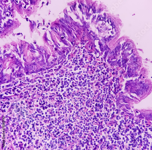 Olfactory neuroblastoma and Non-Hodgkin's lymphoma. Smear show fragmented piece of soft tissue. Malignant neoplasm of atypical small round cells by respiratory epithelium. photo