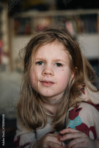 A blond little girl with chickenpox