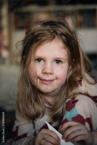 A blond little girl with chickenpox