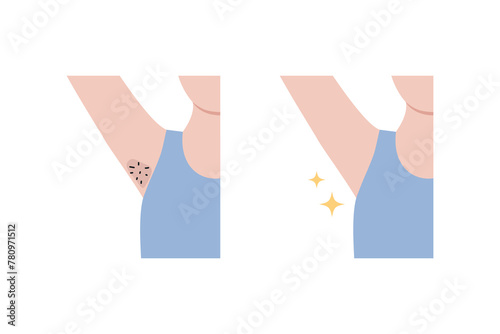 Clean and hairy dark problem underarm armpit icon. Before and after. Hair remove, beauty, laser treatment, waxing, body care concepts. Flat vector design isolated on white background illustration. © Charlottstudio