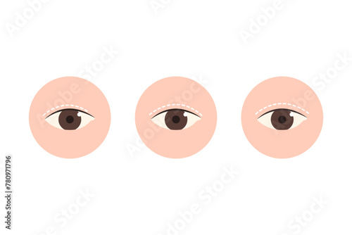 Double eyelid surgery icon set. Beauty, cosmetic, procedure, treatment concept. Flat vector design illustration isolated on white background.