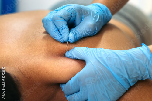 Physiotherapy Clinic: Dry Needling