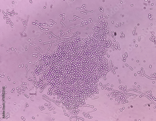 Microscopic fungi Malassezia furfur, showing yeast cells and hyphae. dermatophytes, Nail scraping or skin scraping for fungus test in microbiology laboratory. photo